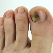 Грибок ногтей на ногах — стадии, формы, особенности лечения и методы терапии грибковых заболеваний